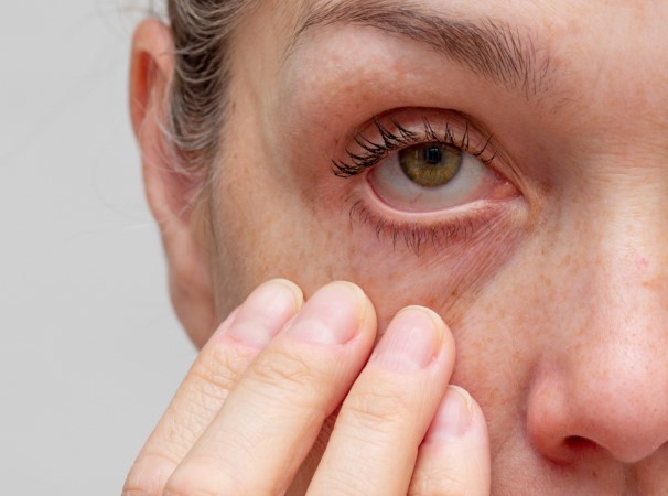 جفاف العين عند الاستيقاظ