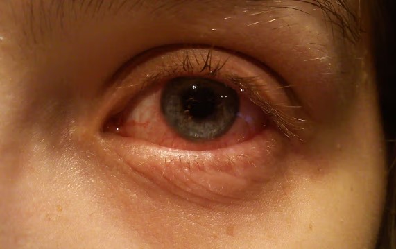 التهاب العين البكتيري 