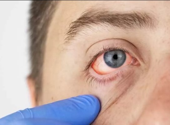 التهاب العين البكتيري 