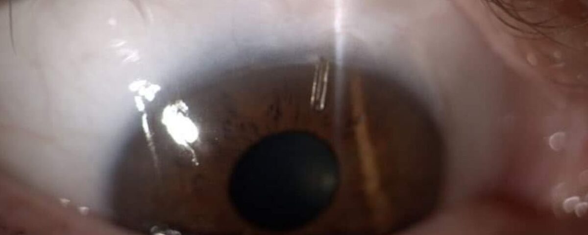 تقنية preserflo microshunt