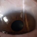 تقنية preserflo microshunt