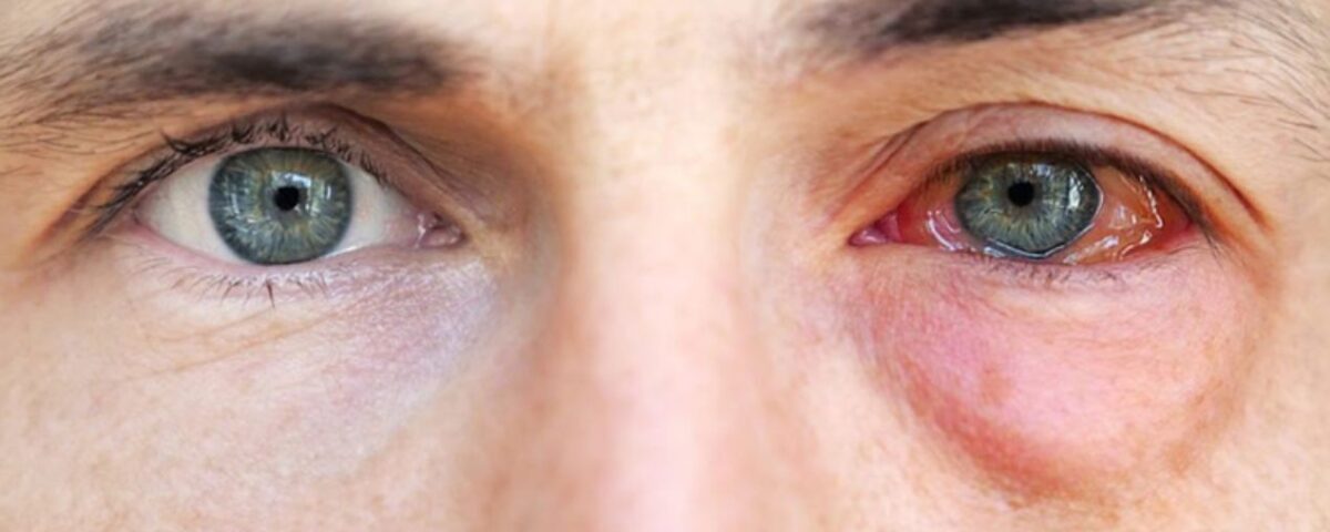 أخطر أعراض التهاب العين التحسسي