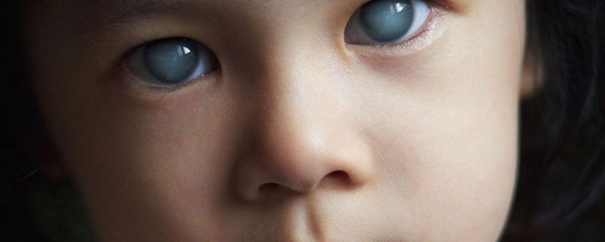 جلوكوما الاطفال