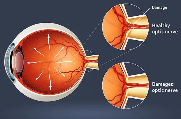 امراض عصب العين