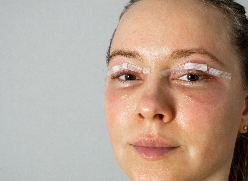 إزالة الغرز الجراحية للعين