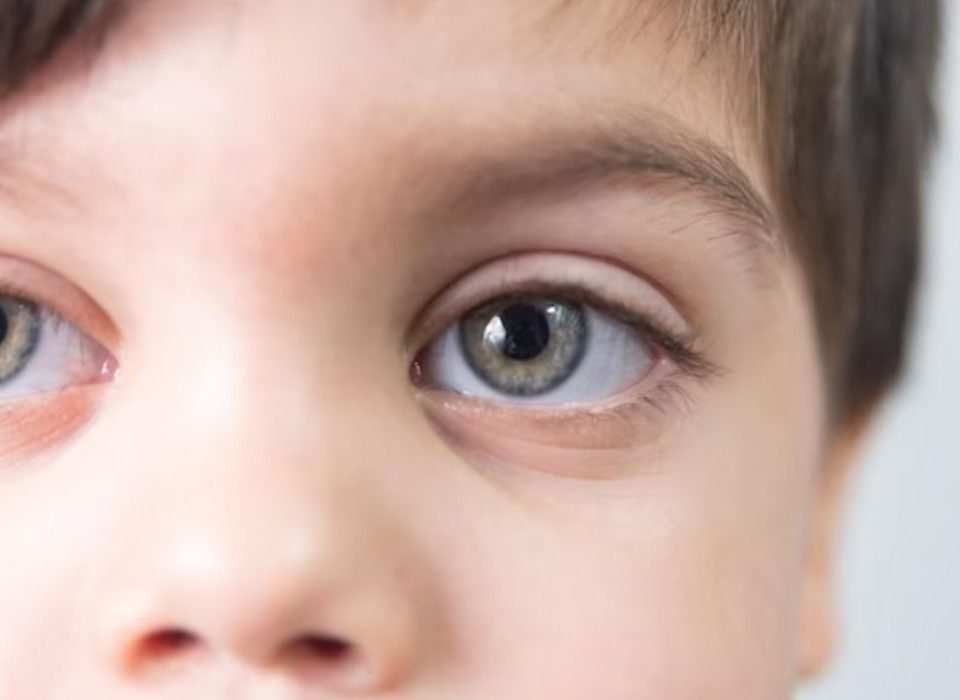 الجلوكوما عند الاطفال