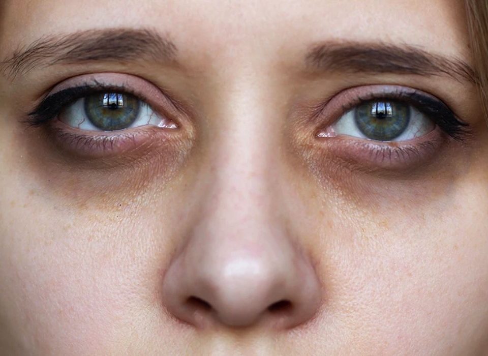 اسباب السواد تحت العين