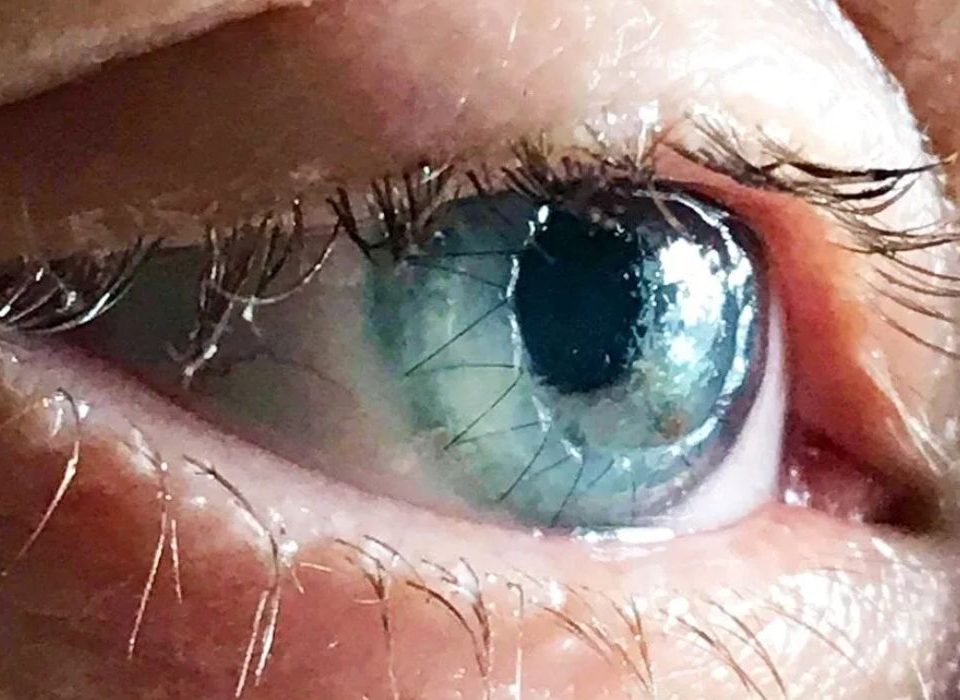 الممنوعات بعد زراعة القرنية