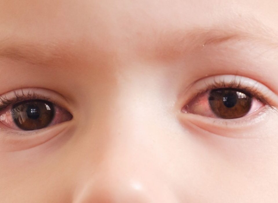 احمرار العين عند الاطفال