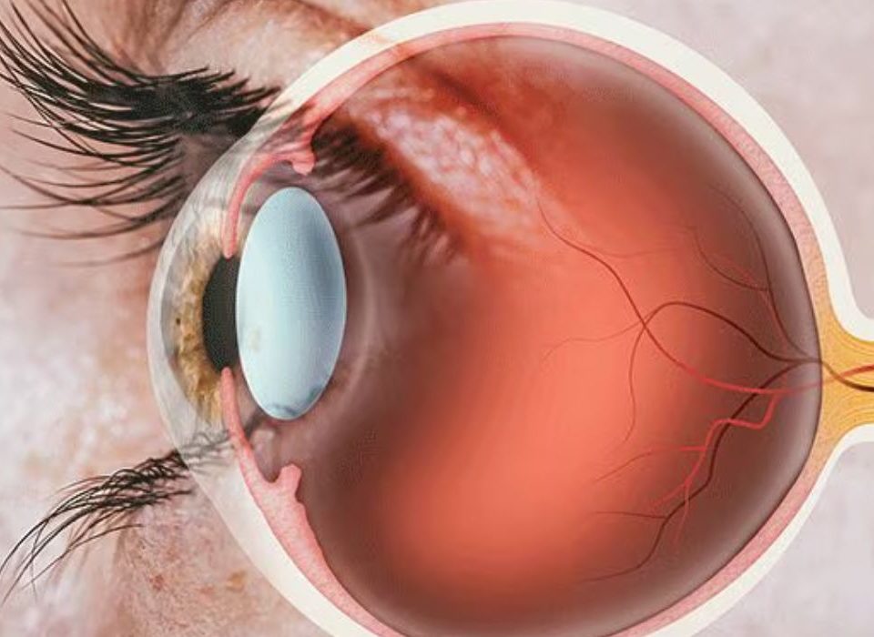 أمراض العيون التي تسبب العمى