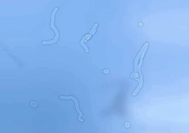 علاج عوائم العين