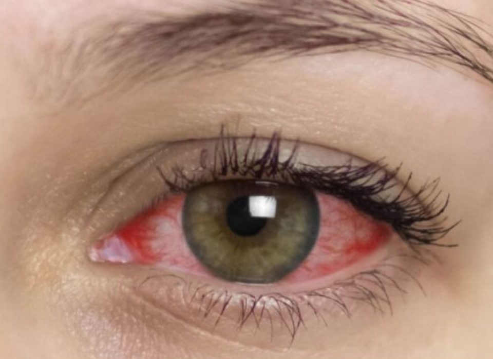 تجربتي مع التهاب القزحية