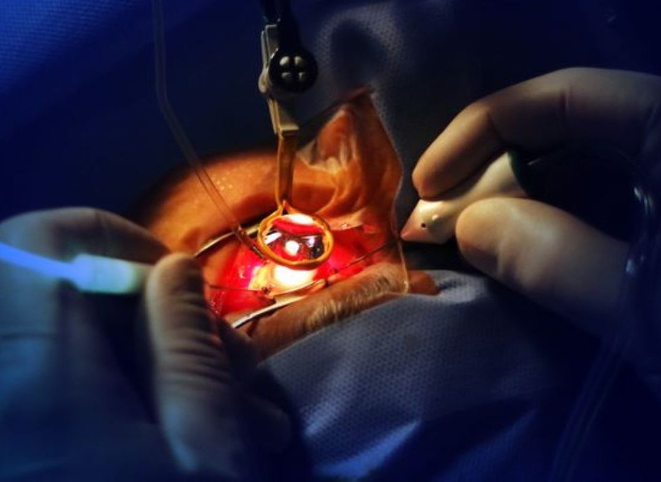 هل عملية انفصال الشبكية ناجحة