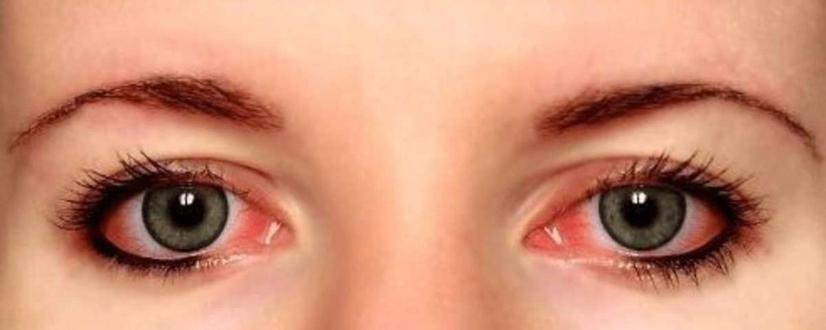 احمرار العين بدون الم