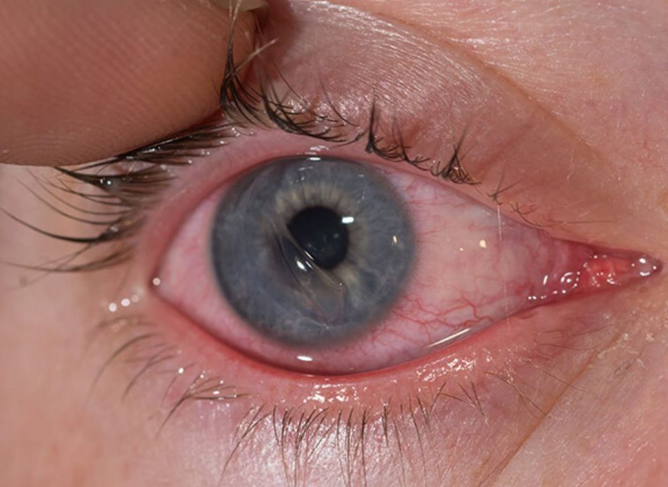 تآكل القرنية