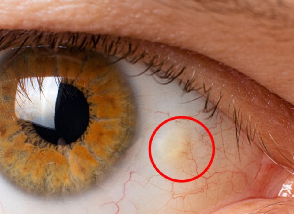 البقعة الصفراء في العين