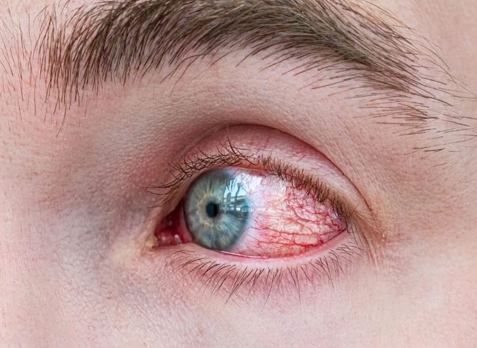 كم يستمر التهاب القرنية