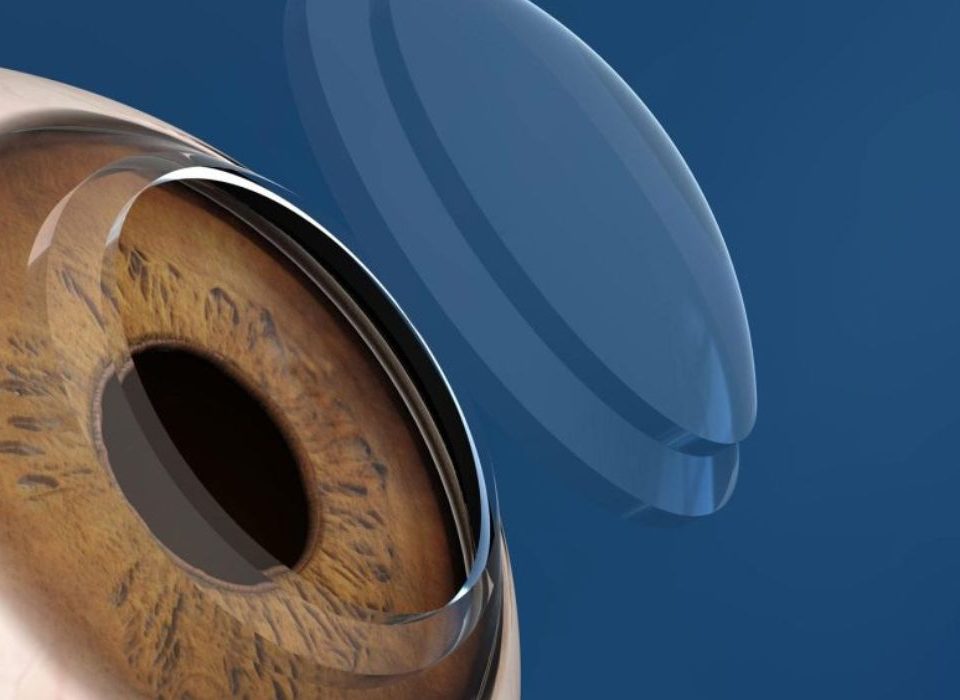 سماكة القرنية الطبيعية