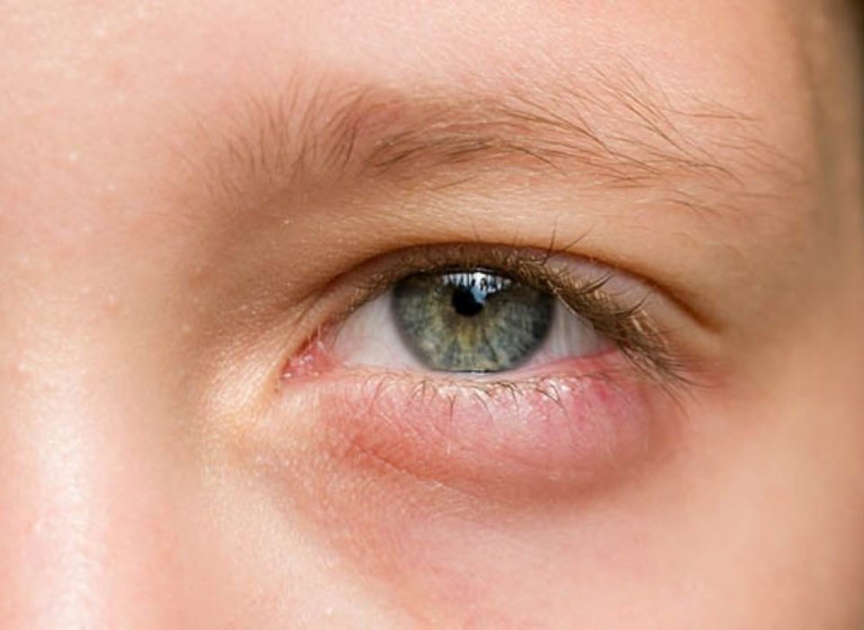 انتفاخ جفن العين السفلي