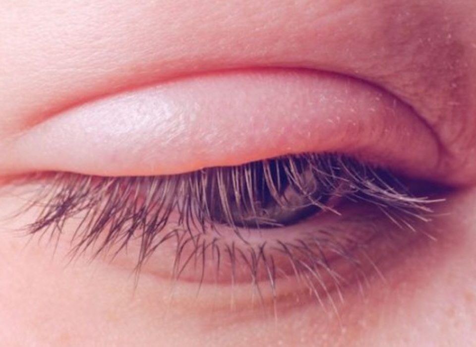 التهاب جفن العين العلوي