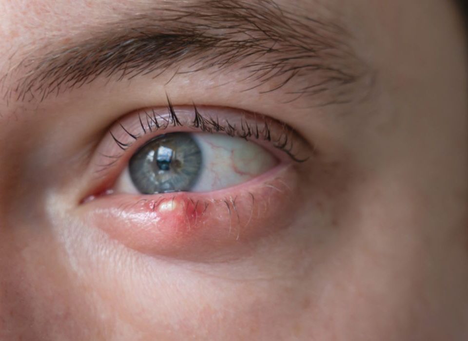 شعيرة العين