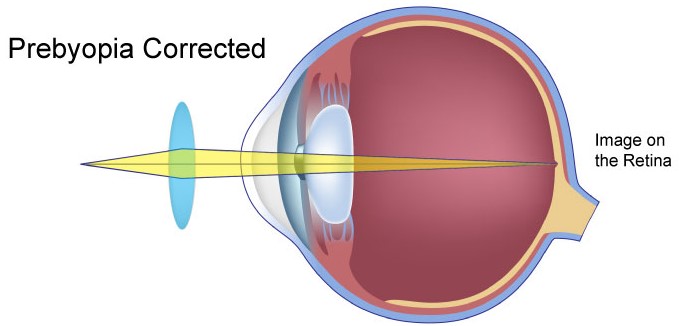 Presbyopia
