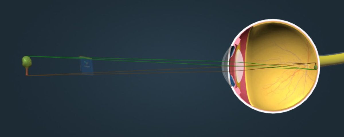 انكسار النظر