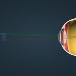 انكسار النظر