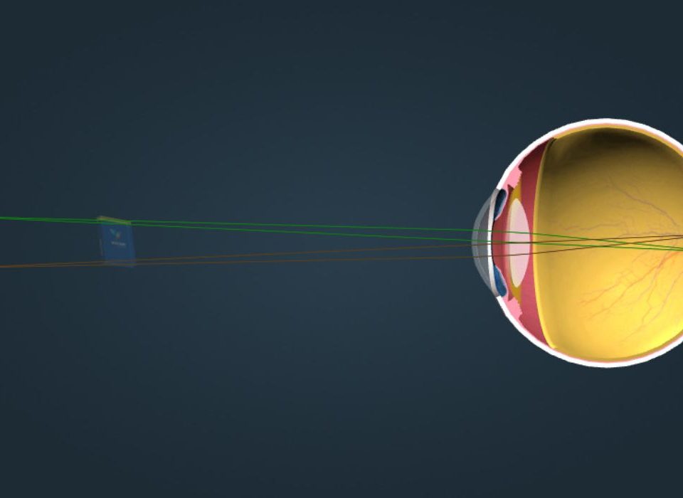 انكسار النظر