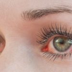 اعراض ارتفاع ضغط الدم العصبي