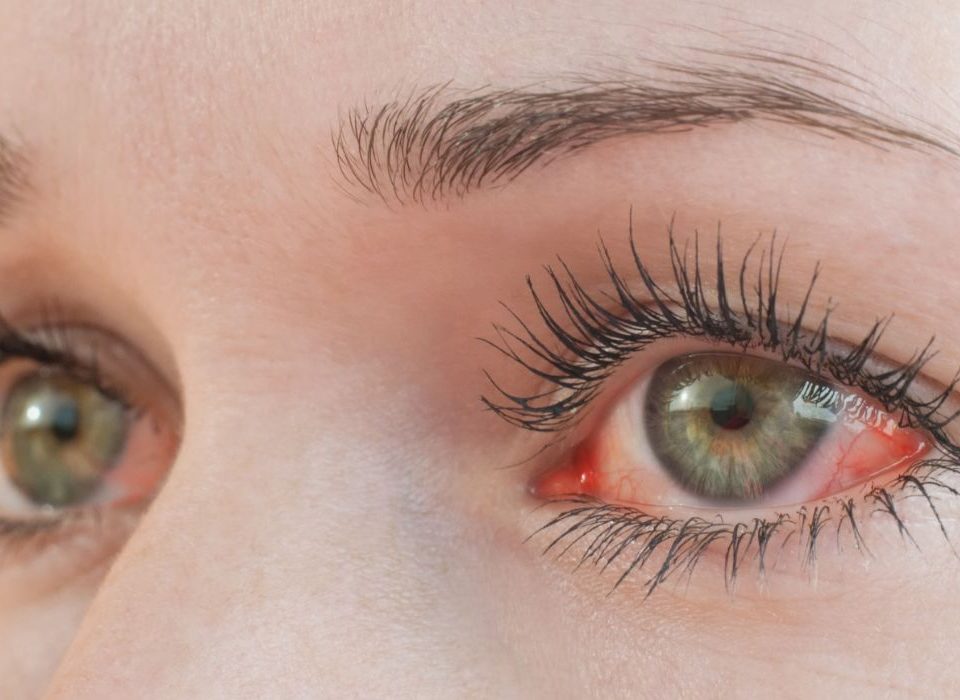 اعراض ارتفاع ضغط الدم العصبي