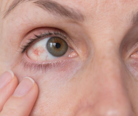 اعراض ارتفاع ضغط الدم العصبي