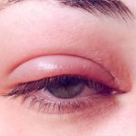 التهاب الجفن Blepharitis