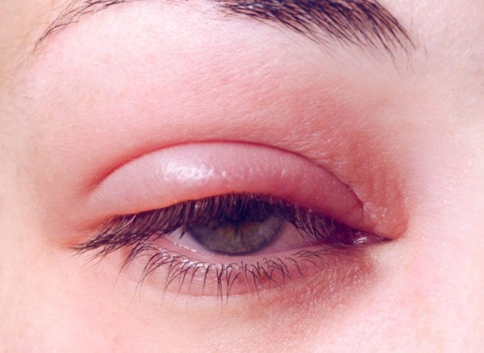 التهاب الجفن Blepharitis