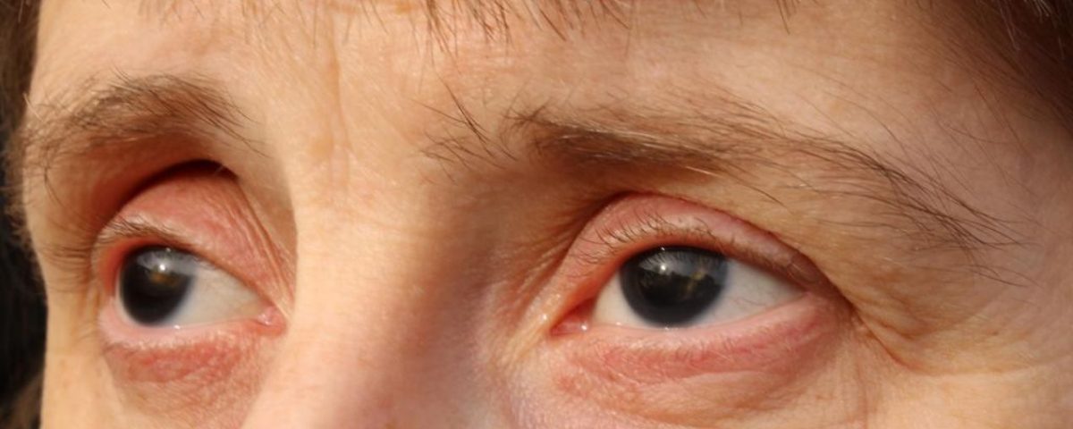 انعدام القزحية Aniridia