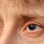 انعدام القزحية Aniridia