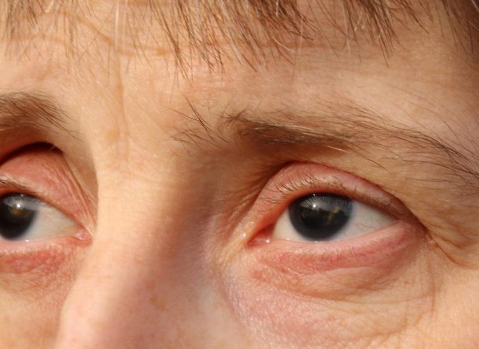 انعدام القزحية Aniridia