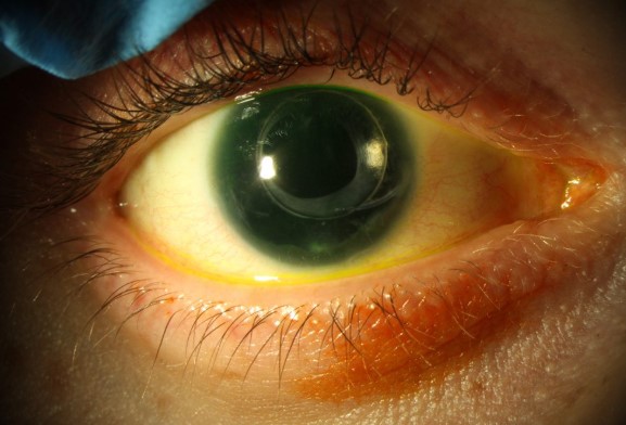 انعدام القزحية Aniridia