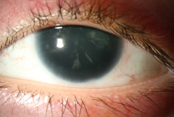 انعدام القزحية Aniridia