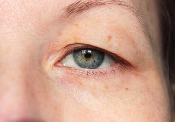 تدلي الجفون