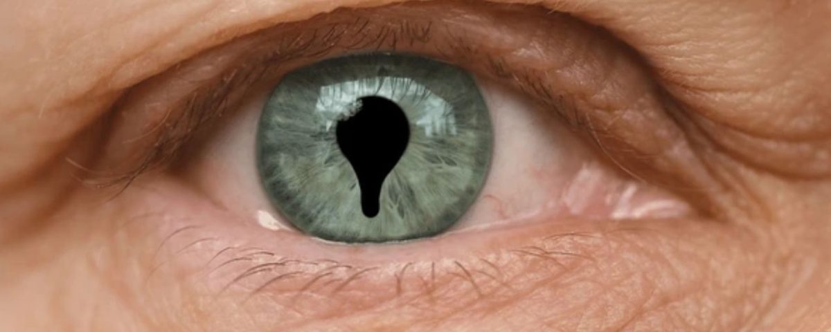 ثلامة العين Coloboma