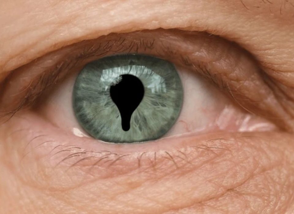 ثلامة العين Coloboma