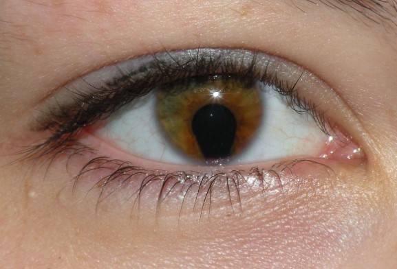 ثلامة العين Coloboma