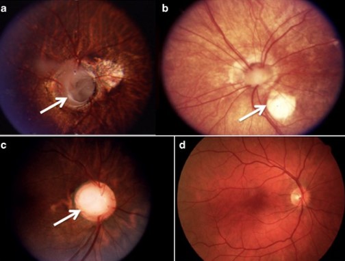 ثلامة العين Coloboma