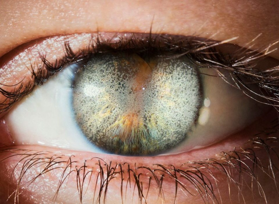 حثل القرنية