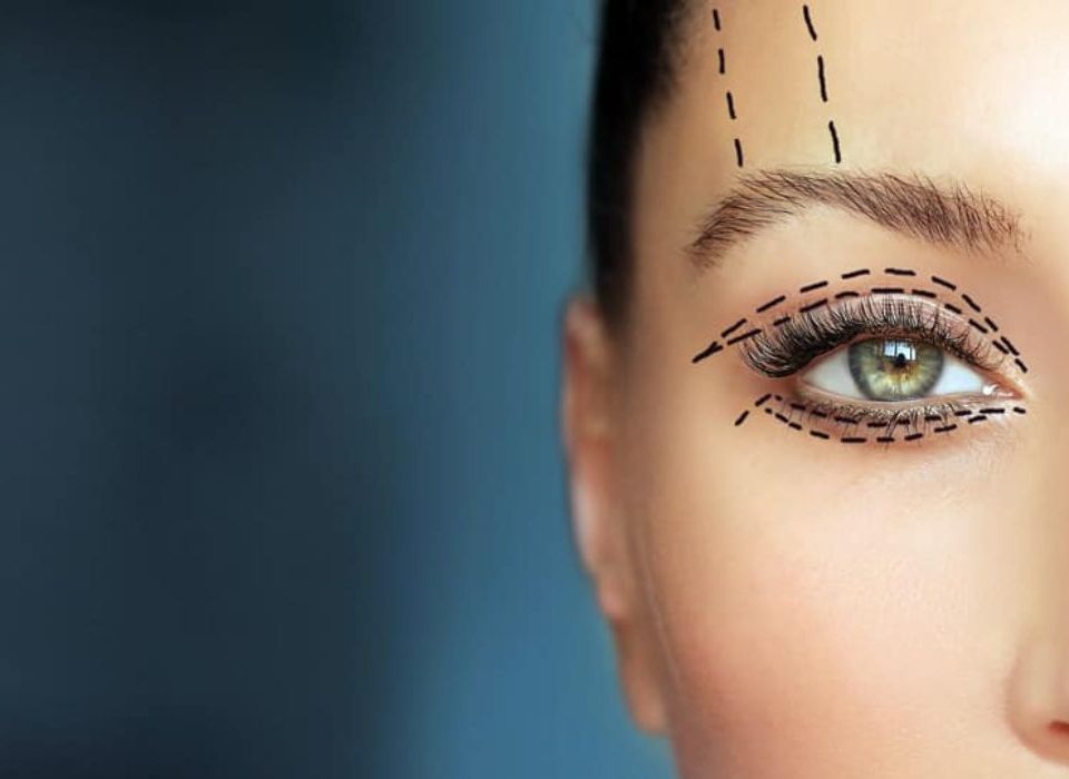 تدلي الجفون