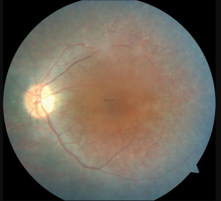 متلازمة آشر Usher Syndrome