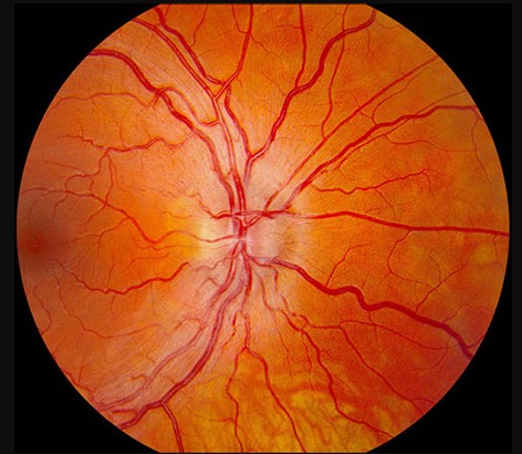 مرض ليبر للضمور البصري الوراثي LHON