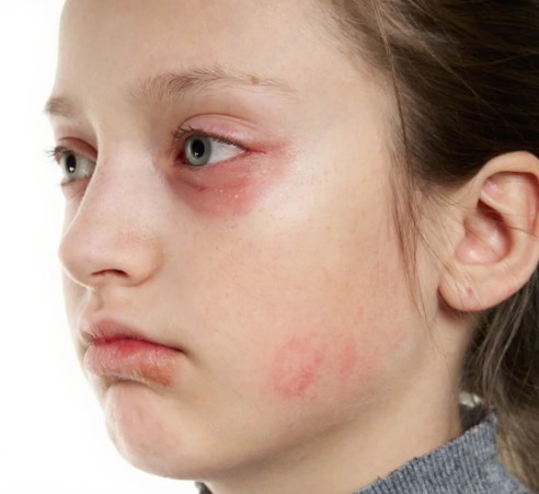 اكزيما العين