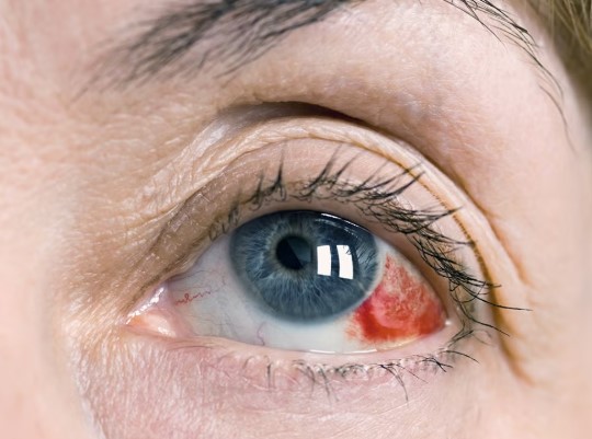 دم في العين